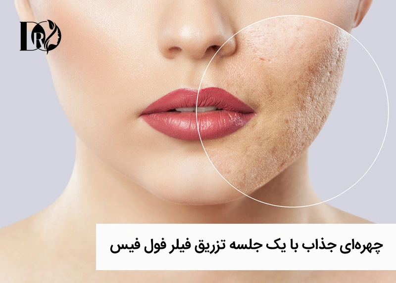 درمالیدی - ایجاد چهرهای جذاب با یک جلسه تزریق فیلر فول فیس در کلینیک دکتر مهدی اوصیا ایجاد چهرهای جذاب با یک جلسه تزریق فیلر فول فیس در کلینیک دکتر مهدی اوصیا