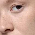 درمالیدی - درمان لکهای پوستی تابستان: راههای موثر برای درمان و پیشگیری درمان لکهای پوستی تابستان: راههای موثر برای درمان و پیشگیری