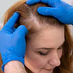 آلوپسی کششی چیست و مدل موی ترند این روزها چگونه باعث طاسی زنان می‌شود؟