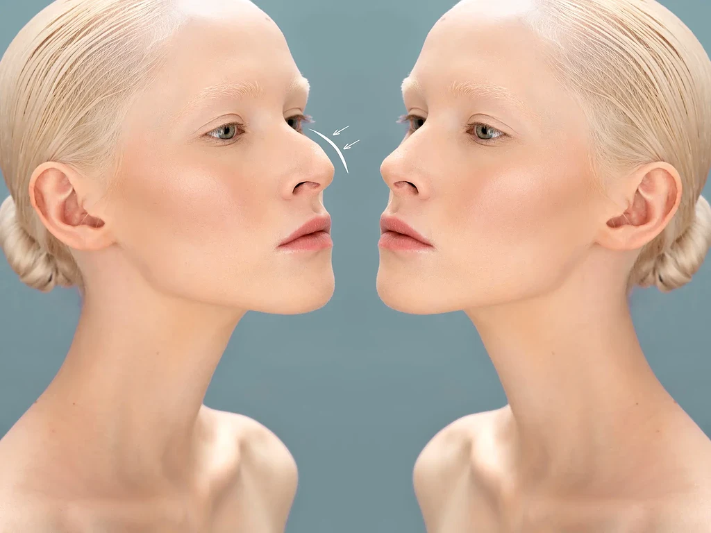قوز بینی شد نماد جذابیت 2026! پایان امپراتوری بینی‌های سربالا و آغاز عصر چهره‌های نچرال