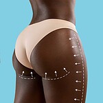 آیا جراحی لیفت باسن برزیلی برای شما مناسب است؟ بررسی کامل پرمخاطره‌ترین عمل زیبایی