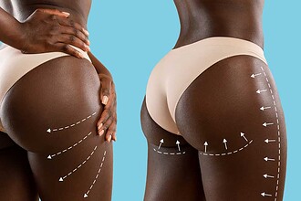 آیا جراحی لیفت باسن برزیلی برای شما مناسب است؟ بررسی کامل پرمخاطره‌ترین عمل زیبایی