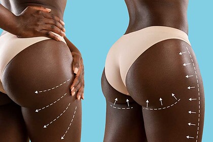 آیا جراحی لیفت باسن برزیلی برای شما مناسب است؟ بررسی کامل پرمخاطره‌ترین عمل زیبایی