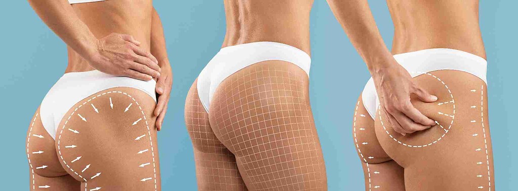 آیا جراحی لیفت باسن برزیلی برای شما مناسب است؟ بررسی کامل پرمخاطره‌ترین عمل زیبایی