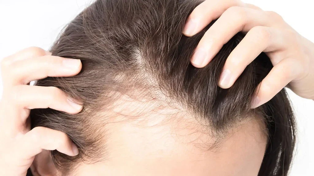 آلوپسی کششی چیست و مدل موی ترند این روزها چگونه باعث طاسی زنان می‌شود؟