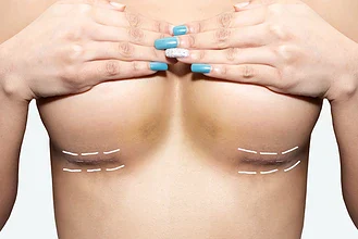 جراحی لیفت سینه (ماستوپکسی): هر آنچه که باید بدانید