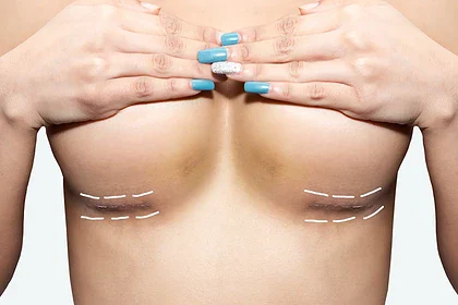 جراحی لیفت سینه (ماستوپکسی): هر آنچه که باید بدانید