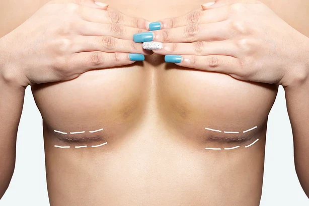 جراحی لیفت سینه (ماستوپکسی): هر آنچه که باید بدانید