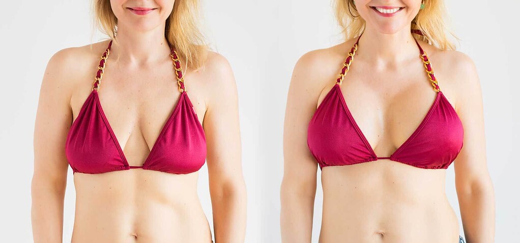 جراحی لیفت سینه (ماستوپکسی): هر آنچه که باید بدانید