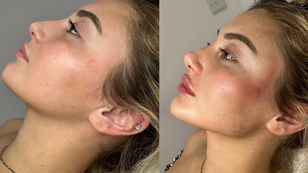 افزایش حجم گونه و تقارن چهره: بررسی تخصصی فیلر گونه به همراه قیمت در سال 1403
